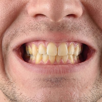 Yellow teeth